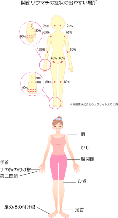 関節リウマチが発症しやすい部位のイラスト