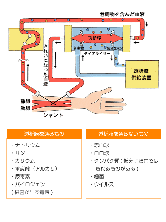 血液透析の仕組みイメージイラスト