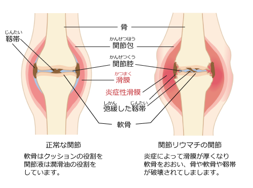 正常な関節と関節リウマチの関節の比較イラスト