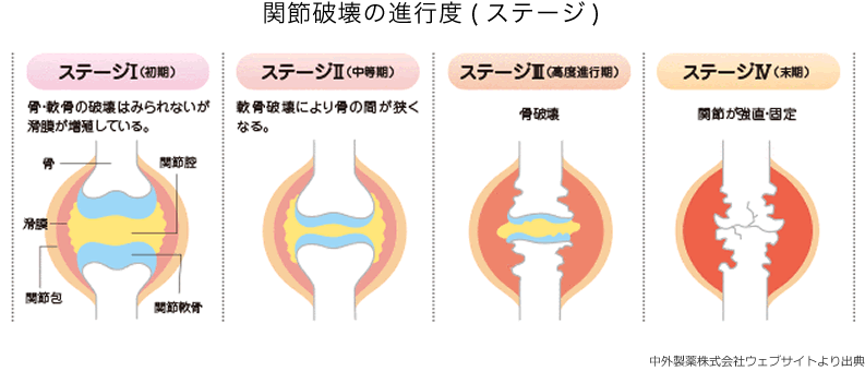 関節破壊の進行度ステージ1～ステージ4までのイラスト